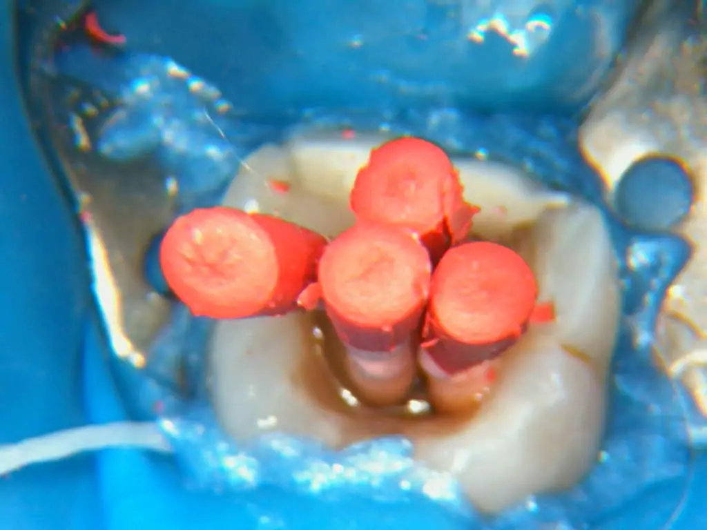 Procedimento endodôntico em dente